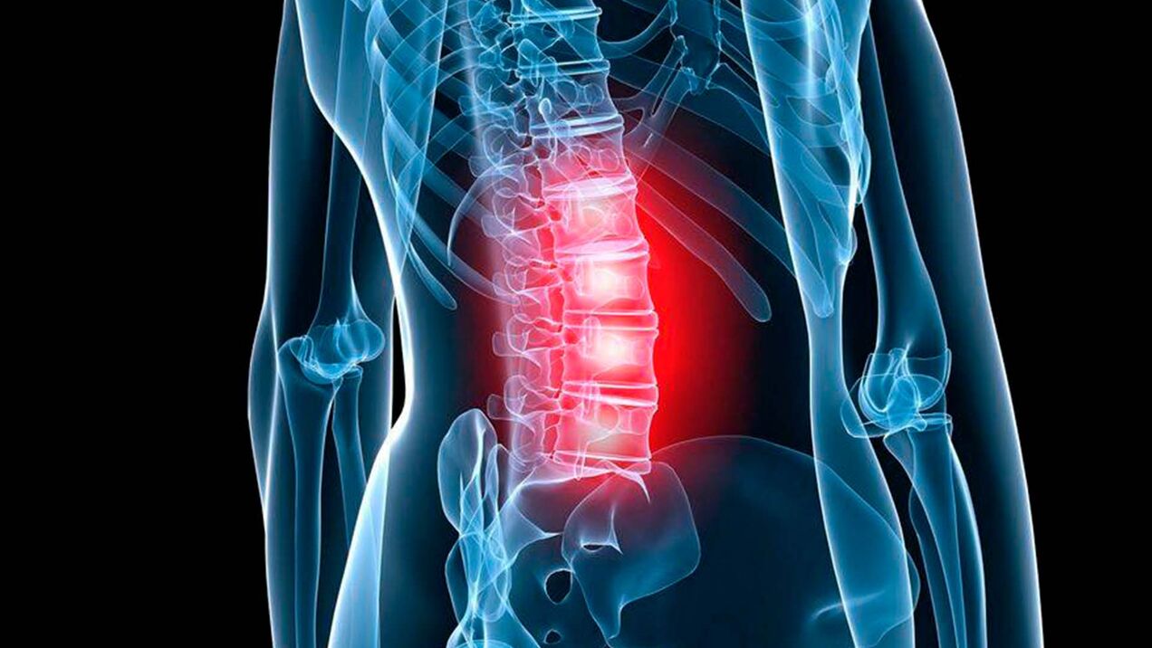 ágyéki osteochondrosis tünetei