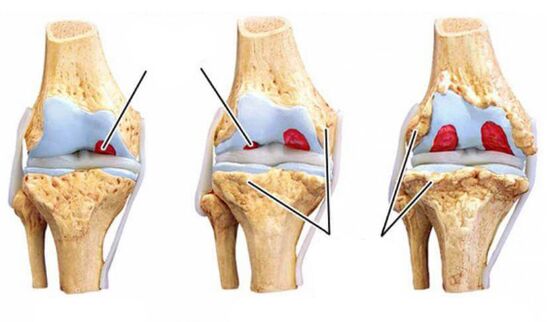 fokos arthrózis
