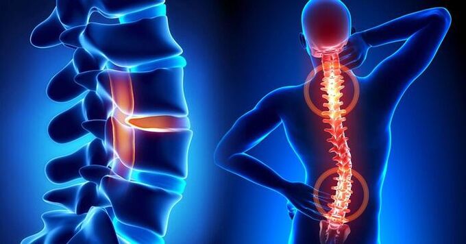 a fájdalom lokalizációja az osteochondrosisban