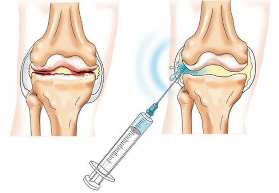 injekció a térdízületbe arthrosisban