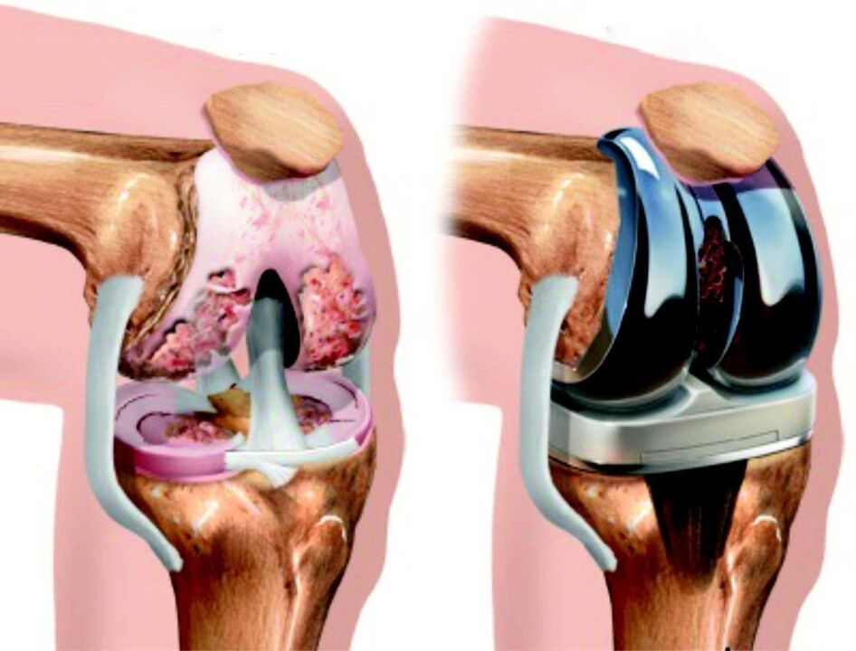 A térdízület arthrosis által okozott teljes károsodása esetén endoprotézissel helyreállítható